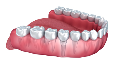 visualisation of a Single-Tooth Implant