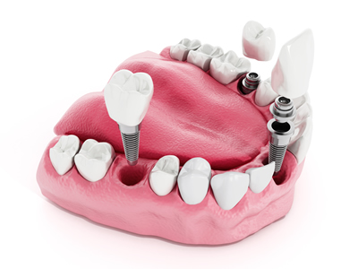 visualisation of Multiple Implants for Full Mouth Reconstruction