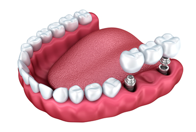 visualisation of an Implant Supported Bridge