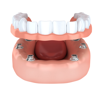 visualisation of Overdentures