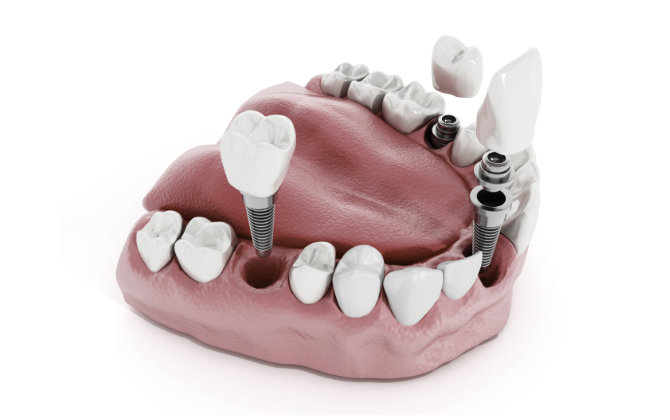 Dental Implants Marietta, GA