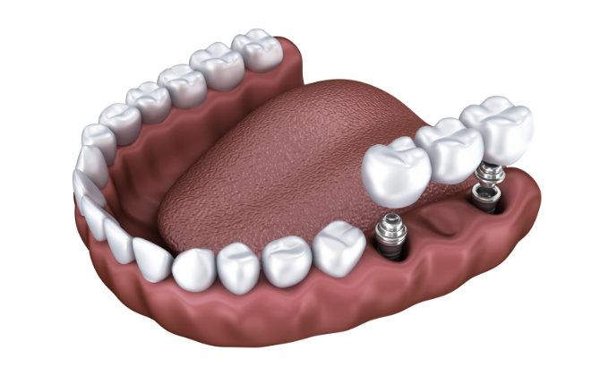 Dental Implants Marietta, GA